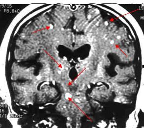 Imagen de resonancia magnética que muestra múltiples metástasis cerebrales (se ven como puntos blancos de diferentes tamaños). Algunas de ellas se muestran con flechas.